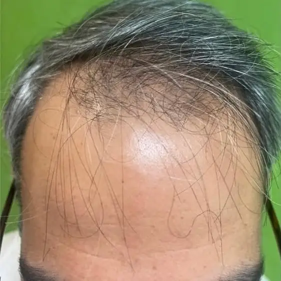 ANTES